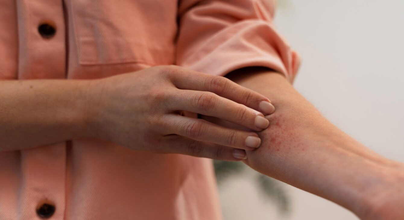 psoriaze-pagrindine-min